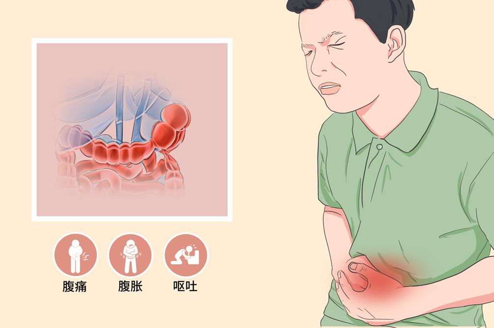 贊！不用開刀，一根導(dǎo)管打通腸梗阻！